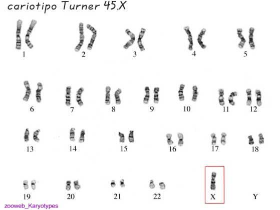 45,X karyotype