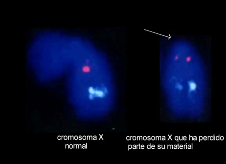 FISH: estudio molecular del cromosoma Y