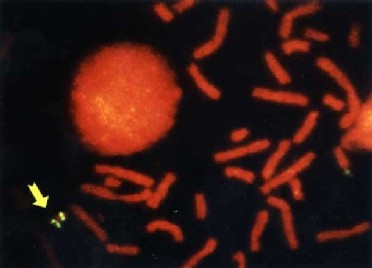 Estudio molecular del cromosoma Y en una mujer con síndrome de Turner