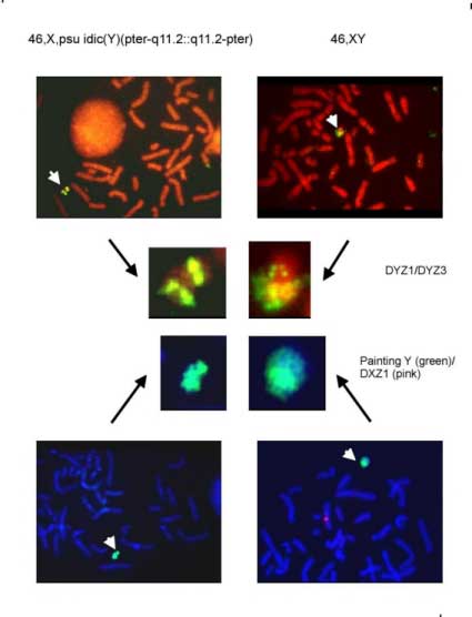 Estudio molecular del cromosoma Y en dos niñas Turner