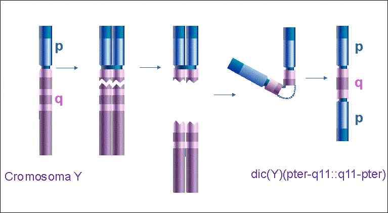 Cromosoma Y dicéntrico (idic Yp)
