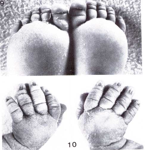 Linfedema de manos y pies